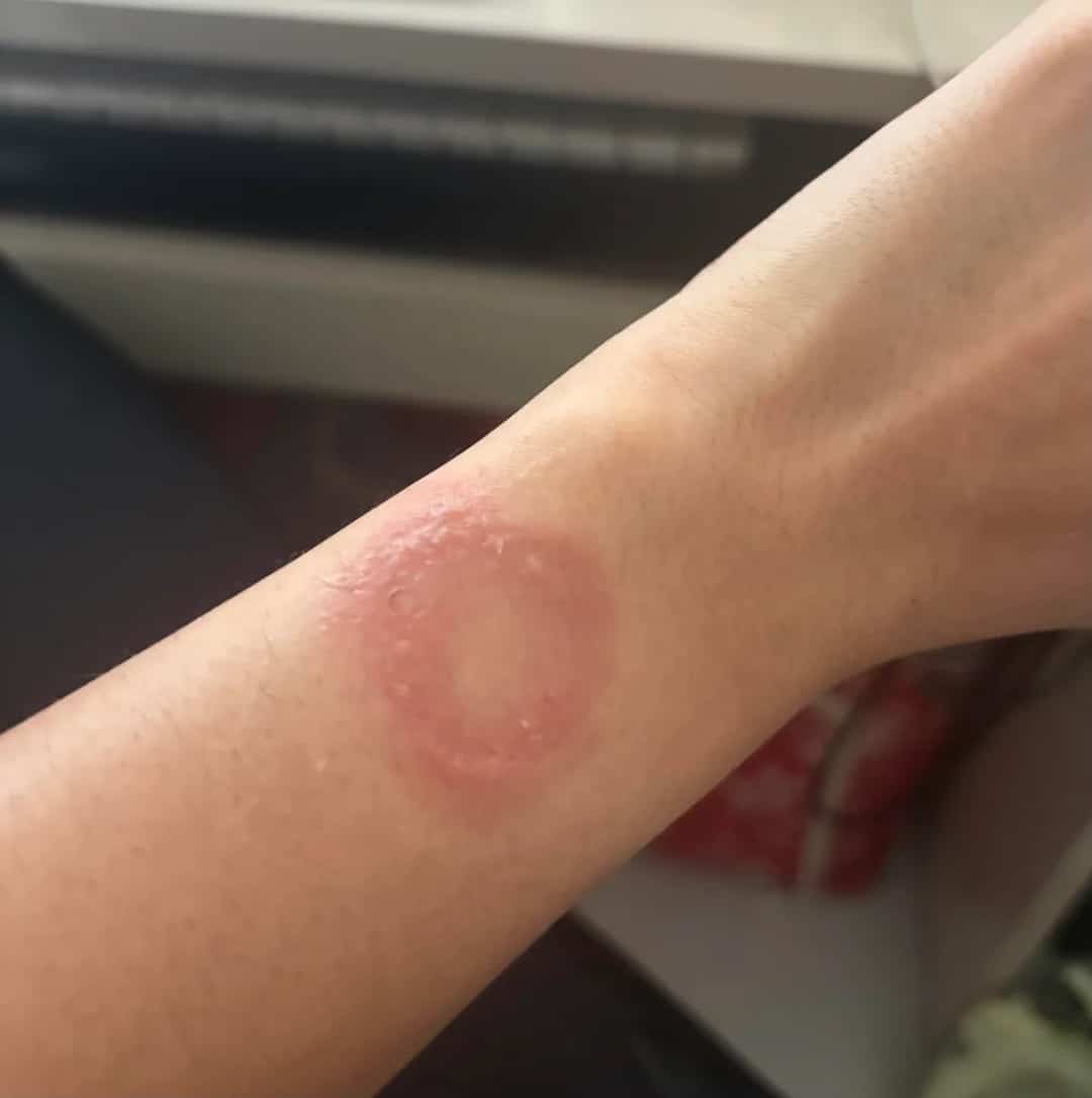 Presunta quemadura con Apple Watch